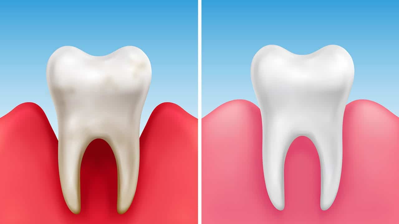 What You Need to Know About Gum Disease